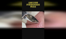 粉刺视频,视频教你轻松应对